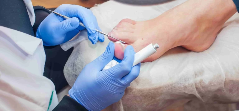 Hongo en Uñas